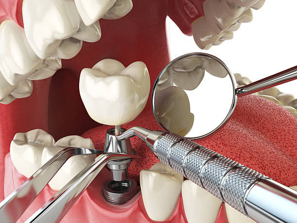 Best Knocked-Out Tooth (Avulsed Tooth) Treatment in Vale, OR